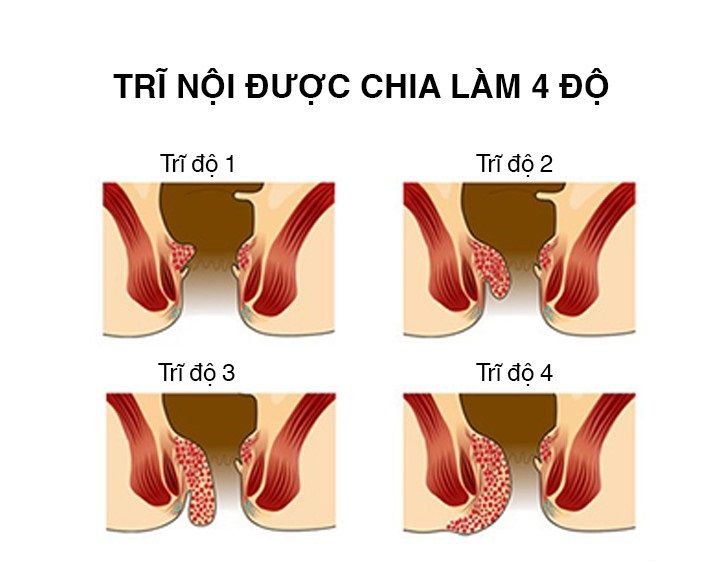 Bệnh trĩ nội và những điều cần biết