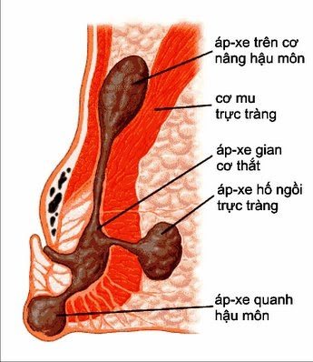 Áp xe hậu môn có những hiện tượng gì?