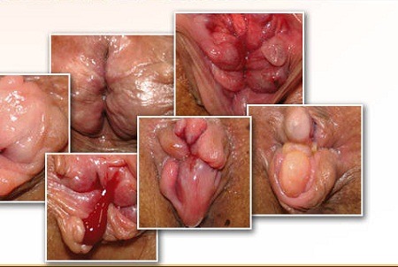 Sự nguy hiểm của bệnh trĩ