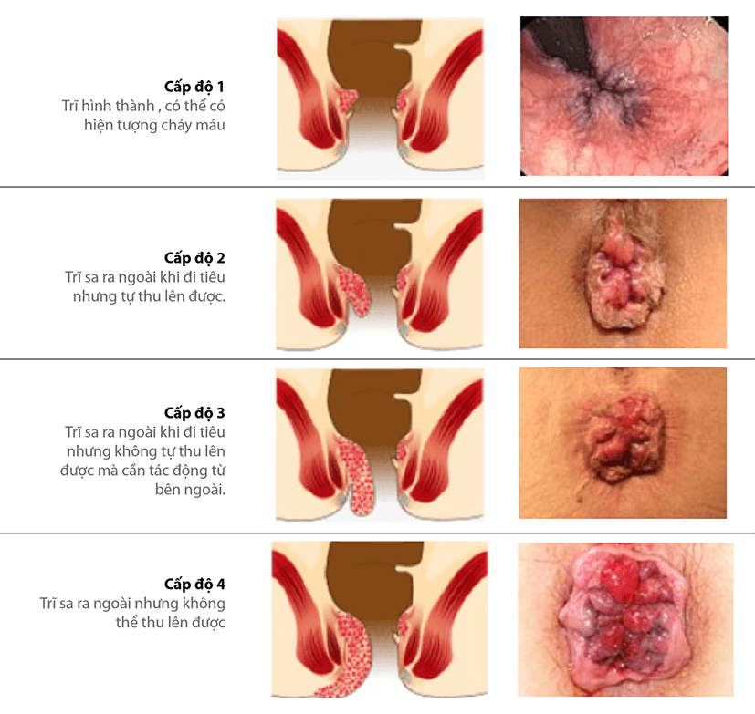 Biểu hiện trĩ nội ở các giai đoạn