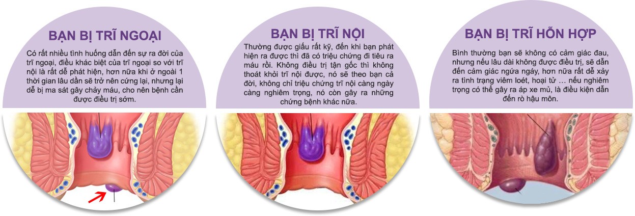 Bệnh trĩ hỗn hợp là gì? Tổng hợp các vấn đề cần nắm rõ!