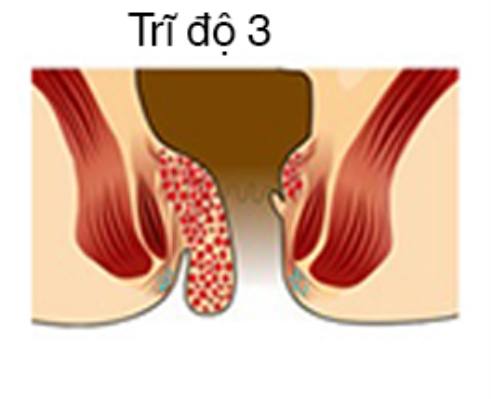 Bị trĩ hỗn hợp độ 3 có những biểu hiện gì?