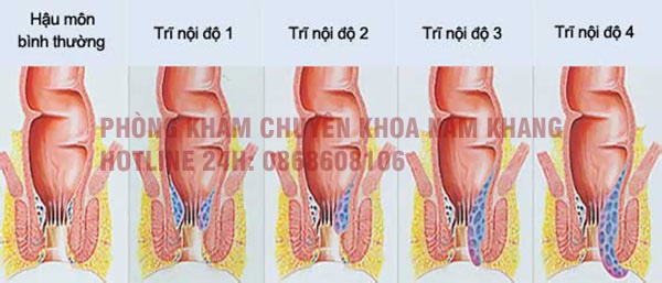 Các cấp độ bệnh trĩ biểu hiện như thế nào?