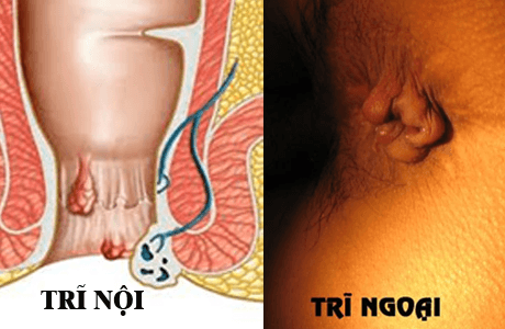 Cách nhận biết bệnh trĩ nội trĩ ngoại