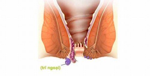 TỔNG QUAN TRĨ NGOẠI