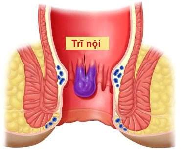 Phương pháp điều trị bệnh trĩ nội