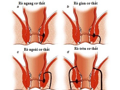 Tổng quan về rò hậu môn