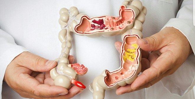 80% bệnh nhân chủ quan với nguyên nhân đi ngoài ra máu