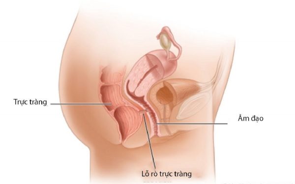 [Điển hình] 5 Triệu chứng thường gặp nhất khi bị rò hậu môn bạn cần biết là gì?