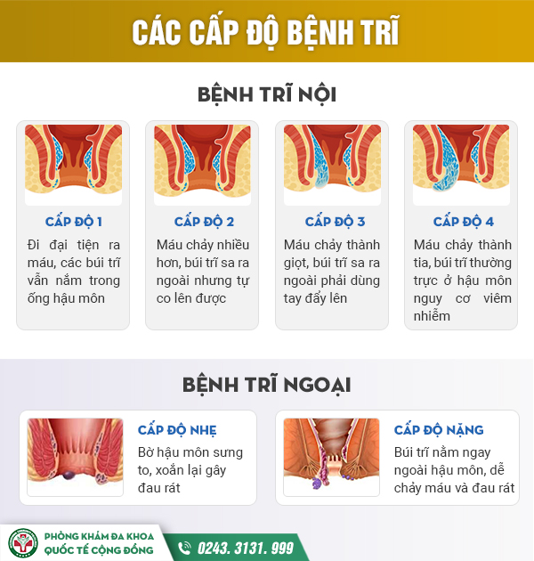 Các cấp độ của bệnh trĩ - Khi nào nên đi khám?