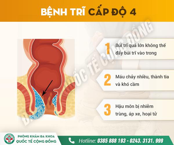 Phát hiện ngay 4 cấp độ trĩ nội trước khi quá muộn