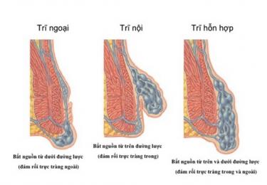 “Trĩ hỗn hợp” 20 năm, tôi đã chữa khỏi như vậy đấy!