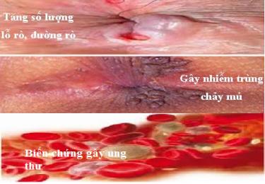 Tác hại bệnh rò hậu môn
