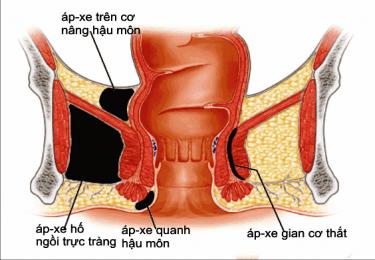 Bệnh áp xe hậu môn là gì?