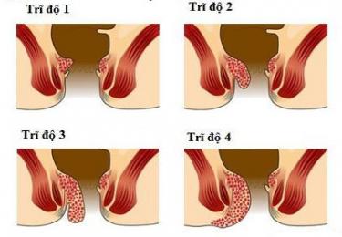 Các triệu chứng của bệnh trĩ nội