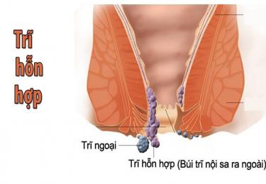 Nguyên nhân gây bệnh trĩ hỗn hợp