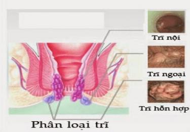 Triệu chứng của bệnh trĩ hỗn hợp