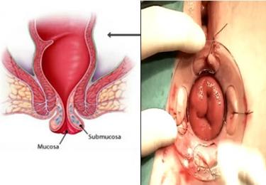 Triệu chứng bệnh sa trực tràng