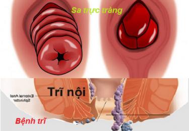 Mối nguy hại của bệnh sa trực tràng