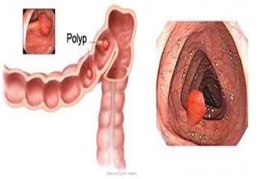 Polyp hậu môn và những điều cần biết