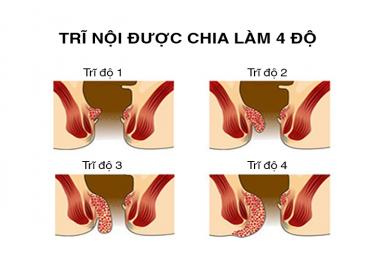 Bệnh trĩ nội là gì?
