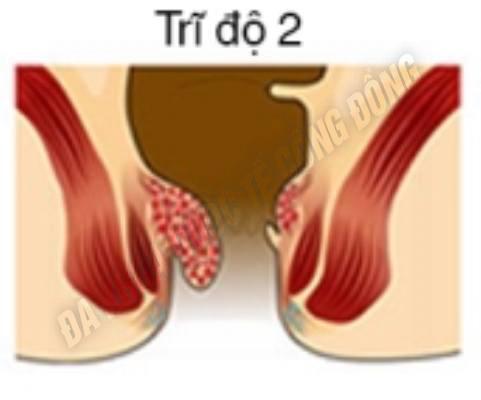 Bệnh trĩ độ 2