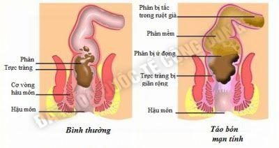 bệnh trĩ