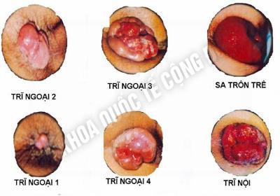 các giai đoạn của bệnh trĩ ngoại