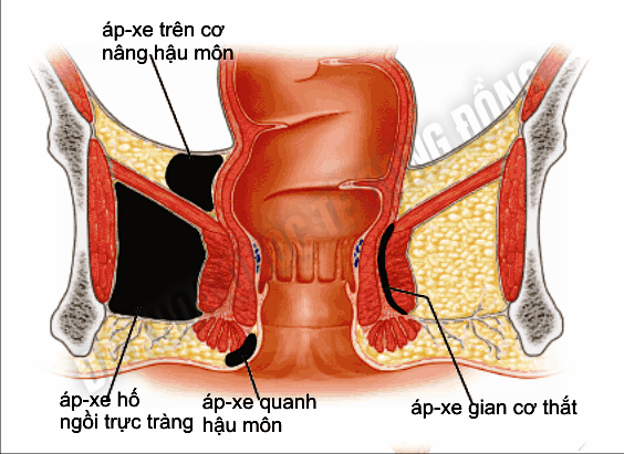 benh-ap-xe-hau-mon_2