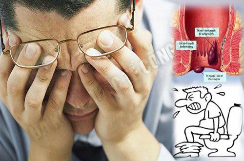 trĩ ngoại nhồi máu 
