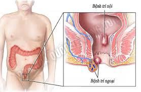 Cách trị bệnh trĩ ngoại
