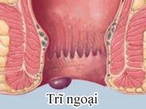 benh-tri-noi-tri-ngoai-la-gi-va-cach-nhan-biet1