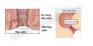 nut hau mon 2