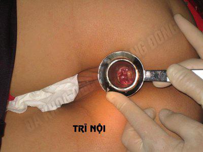 tri noi 10